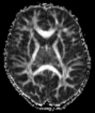 Diffusion MR images