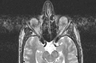 motion artifact mri