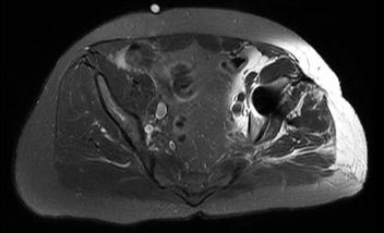 CHESS/Fat-Sat Pulses artifact