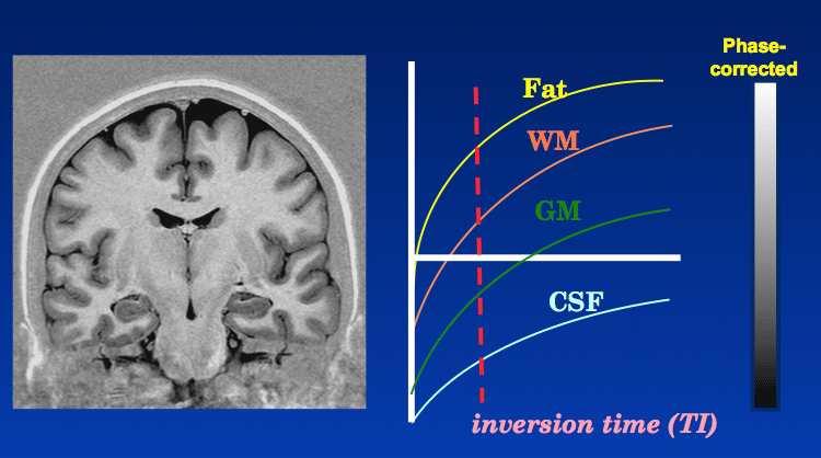 Phase Sensitive Inversion Recovery Questions And Answers In Mri