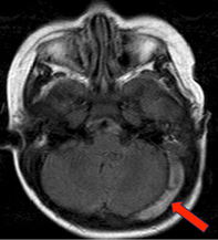 slow flow v thrombosis MRI