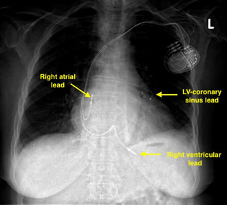 biventricular pacemaker