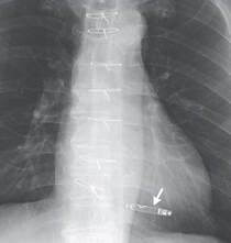 Nanostim® leadless pacemaker