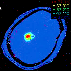 MR thermography LITT procedure