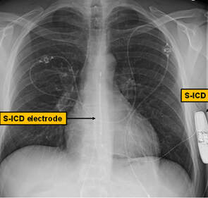 subcutaneous S-ICD