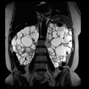 HASTE/SS-FSE kidneys