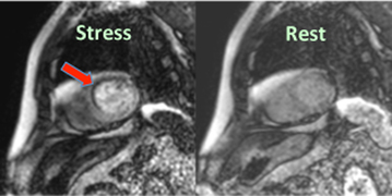 inducible myocardial ischemia MRI