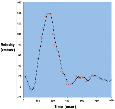 phase contrast MRA flow measurement