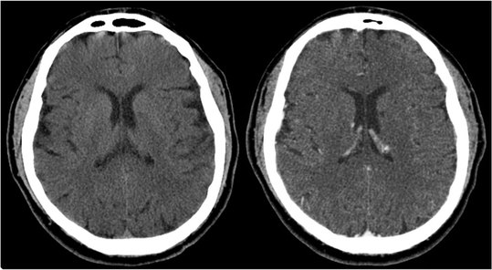 gadolinium on CT