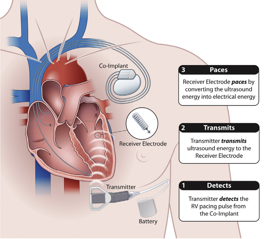 pacemaker-terminology-questions-and-answers-in-mri